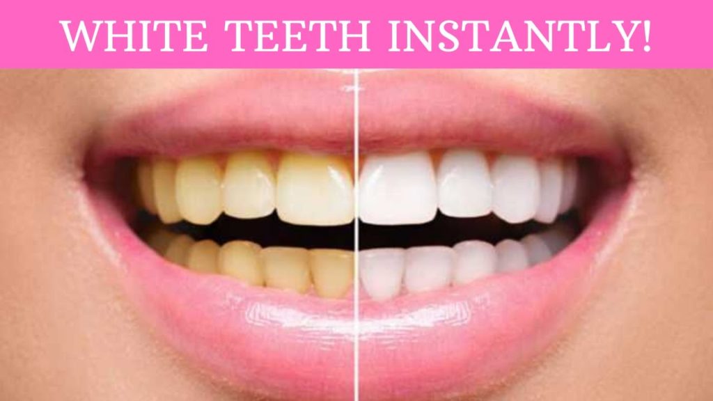 how to get white teeth overnight