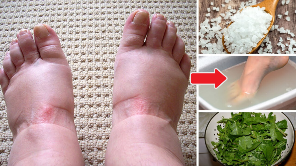 home remedies for swollen feet